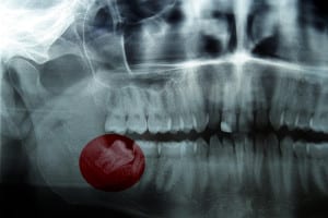 important questions about wisdom teeth