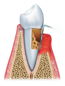 kaniagumgraft