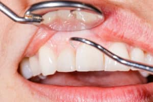 kania gum disease prevention