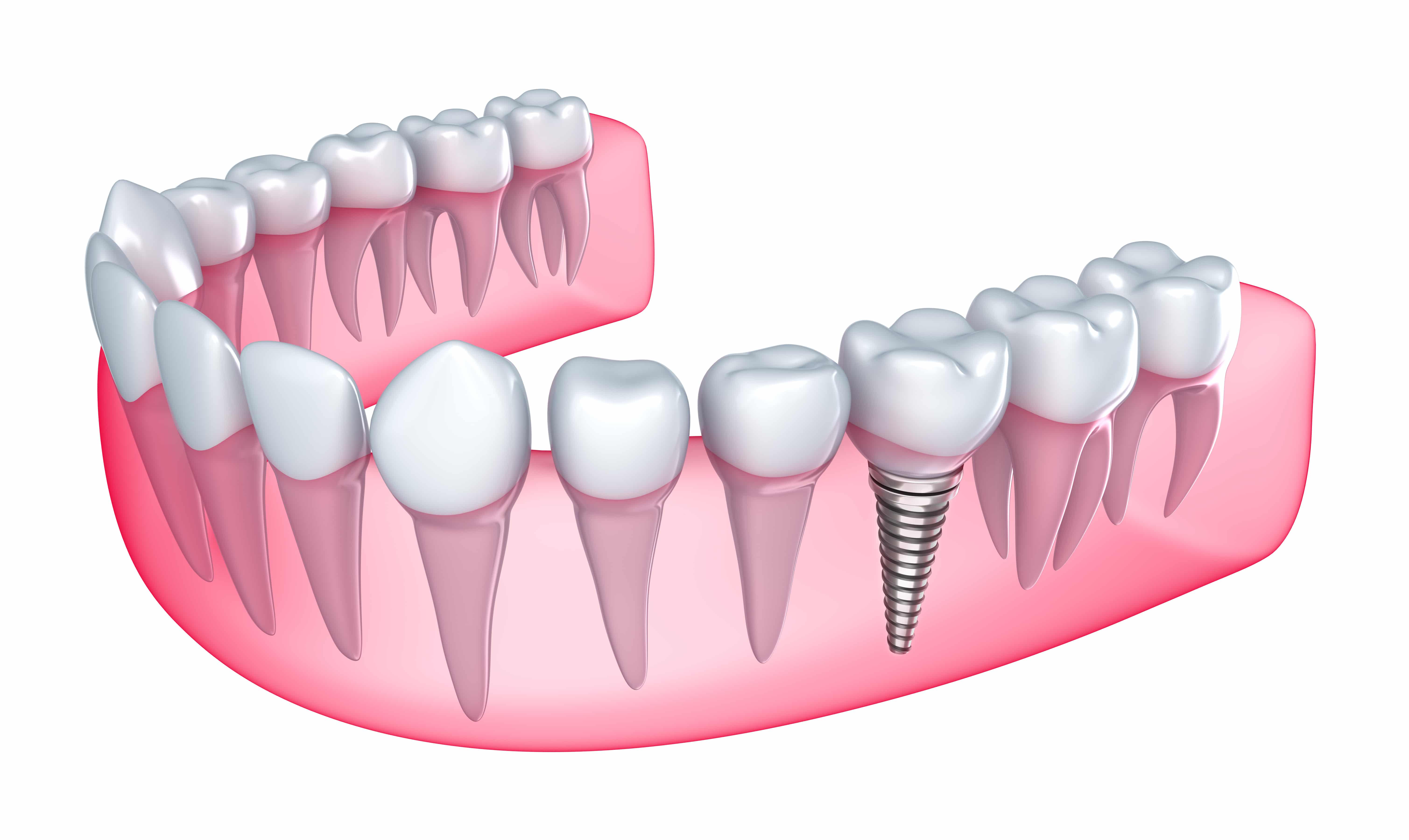 India Westbrooks Implants