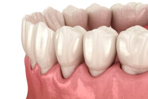 encinitas gum disease