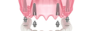san diego dental implants