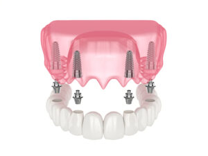 san diego dental implants