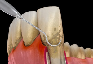 encinintas plaque buildup