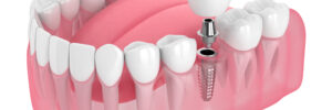 encinitas dental implants