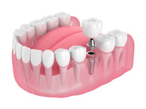 encinitas dental implants