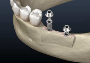 encinitas jawbone grafting