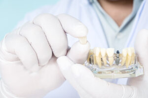 encinitas dental implants