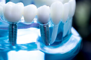 Encinitas dental implants