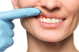 encinitas gum disease treatment