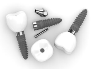 encinitas dental implant