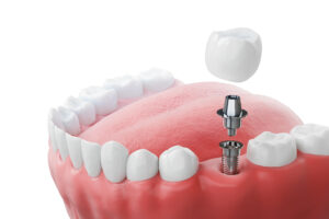 encinitas dental implants