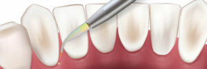 encinitas laser dentistry