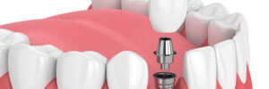 encinitas dental implants