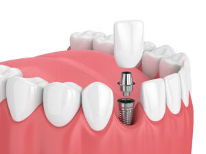 encinitas dental implants