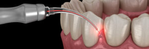 encinitas laser dentistry