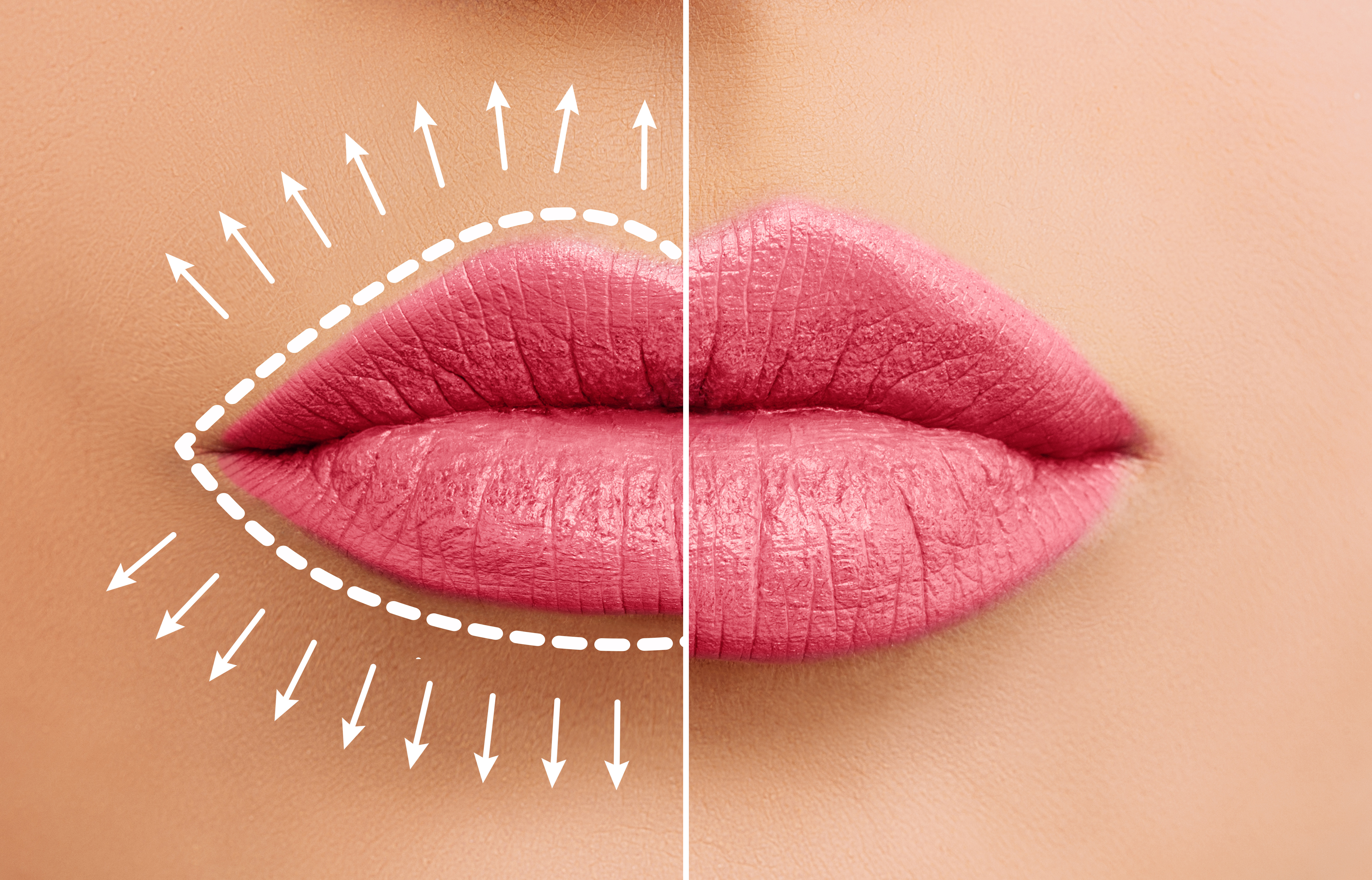 Lasers Offer Dermal Filler Alternatives
