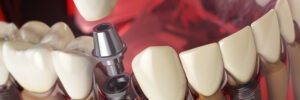 encinitas dental implants