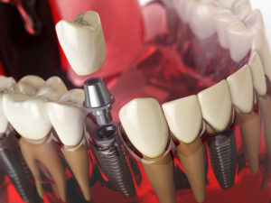 encinitas dental implants