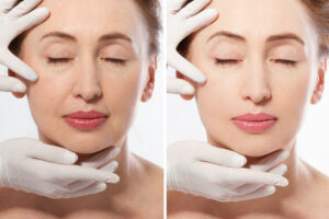 Encinitas laser fillers