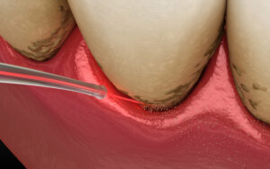 encinitas laser repair