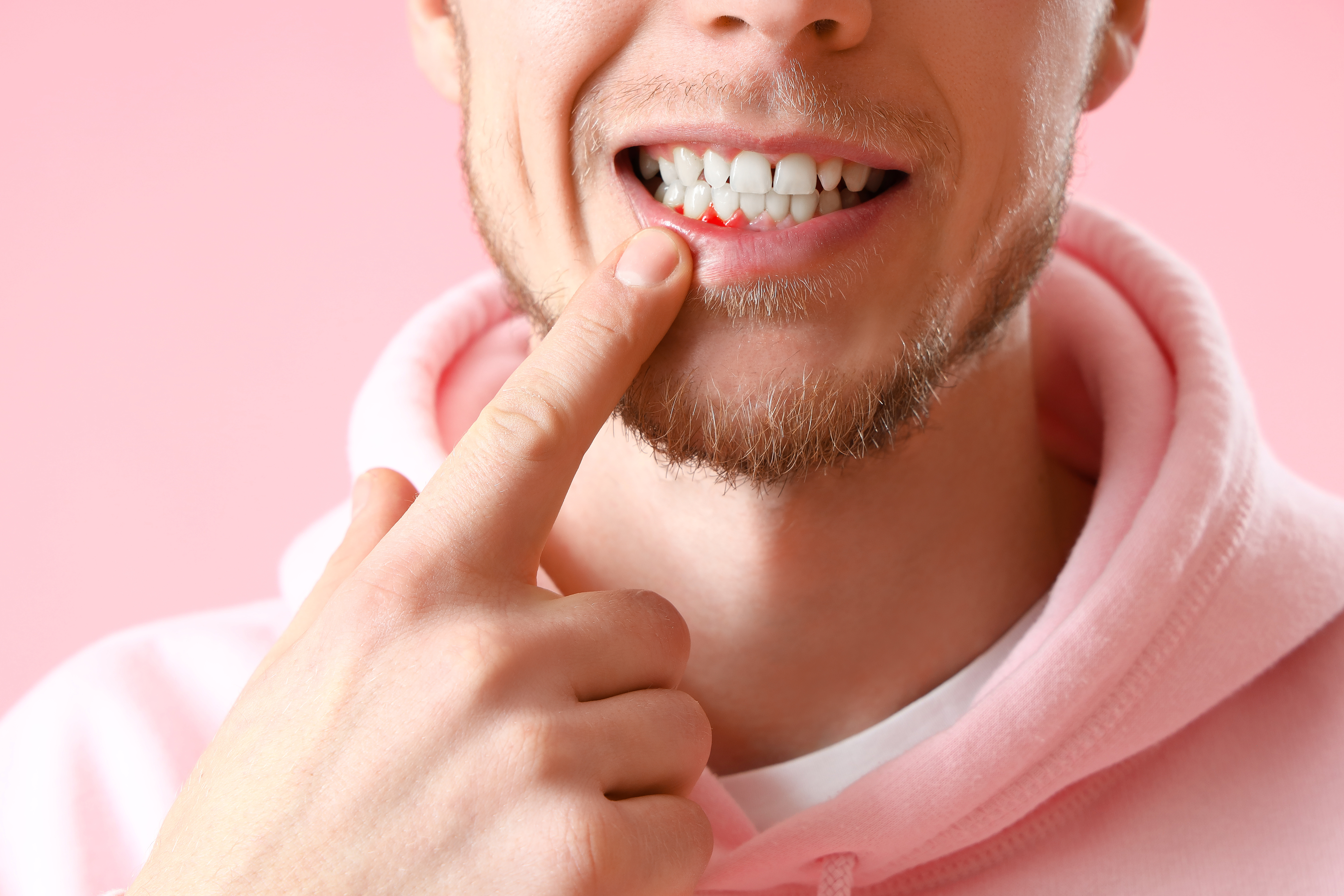 Man with gum inflammation on pink background, closeup
