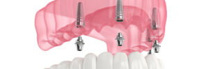 encinitas dental implants