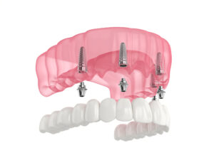 encinitas dental implants