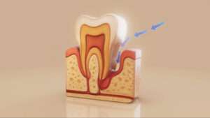 encinitas gum recession